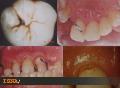 فهرست بیماریهای ناشی از عدم رعایت بهداشت دهان و دندان