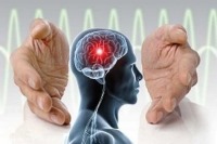 افزایش خطر بروز سکته مغزی با کم آبی بدن