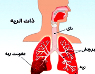 عفونت ریه هر 20 ثانیه جان یک نفر در دنیا را می‌گیرد
