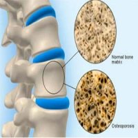 افزایش موفقیت در درمان استخوان مرمری با سلول‌های بنیادی