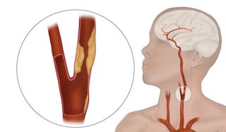 گرفتگی عروق گردن از عوامل مهم بروز سکته مغزی است