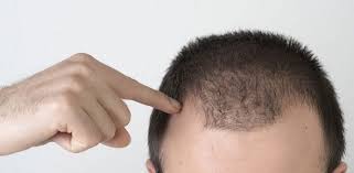 7 راه موثر برای خلاصی از ریزش مو