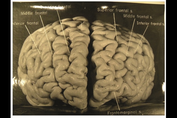 مغز انیشتین زیر تیغ جراحی+عکس 1
