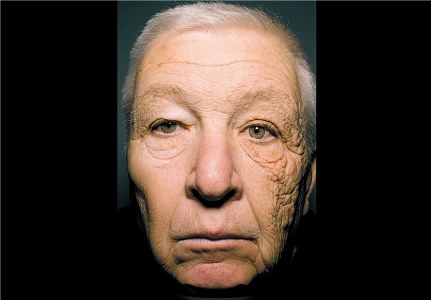 درمان سرطان پوست با نوعی باند پوششی!