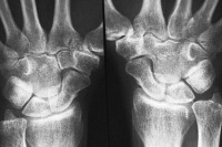 مقاوم‌ترین غضروف جهان ساخته شد