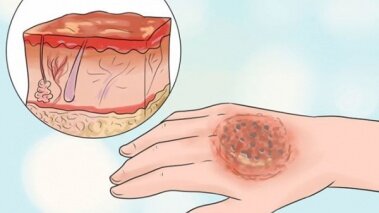 اختراع پماد التیام‌بخش سریع زخم‌های سوختگی