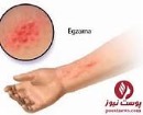 اگزما چیست؟
