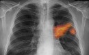 تشخیص زودهنگام سرطان ریه با گازهای موجود در تنفس بیماران
