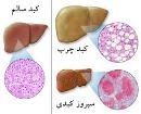 کبد چگونه چرب می‌شود؟