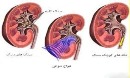 چه زمانی کیست کلیه خطرناک می‌شود