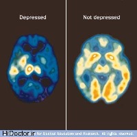 با سرد شدن مغز افسرده می شوید