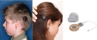 نسل جدید ایمپلنت‌های شنوایی بلوتوث‌دار
