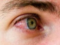 تاری دید مهمترین علامت بیماری ماکولا