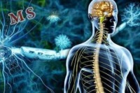 چه عواملی سبب ابتلاء به بیماری ام اس می‌شود