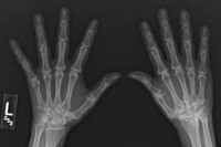 درمان زودهنگام آرتریت روماتویید یک ضرورت است