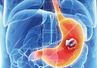 لاغری شدید زنگ هشداری برای سرطان معده