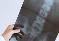 هر آنچه درباره پوکی استخوان باید دانست