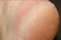 ارتباط مستقیم تیروئید و خشکی پوست پا