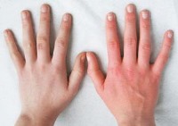 راه‌های مقابله با خشکی پوست در فصول سرد