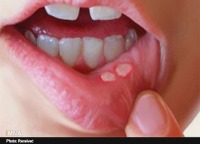 در طب سنتی عامل آفت دهان کبد است
