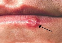 ماساژ سیر؛ درمان زگیل‌های سرسخت