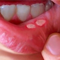 روش‌های پیشگیری از بروز آفت دهان