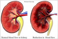 نشانه‌های عفونت کلیه را بشناسید