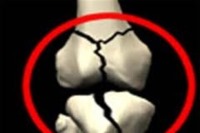 سالمندی بدون پوکی استخوان