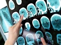 این نشانه‌ها را جدی بگیرید! شایدبه ام اس مبتلا شده اید