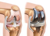 پروتز مفصل زانو برای معلولان سنگین وزن ساخته شد