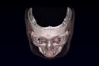 درمان یک اختلال بینایی با اهن ربا !