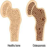 آموزش بیماران مبتلا به پوکی استخوان