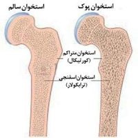 مرگ با استخوان های پوک