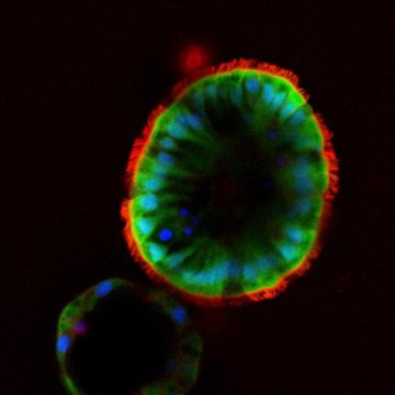 درمان شخصی فیبروز سیستیک در راه است