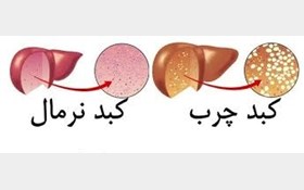 مبارزه با بیماری کبد چرب با 7 نکته رژیمی!