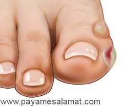 چگونه «تاول پا» را درمان کنیم؟