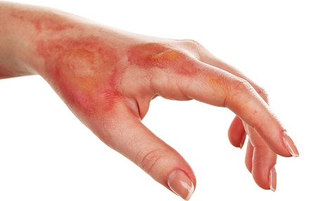 درمان خانگی سوختگی ها