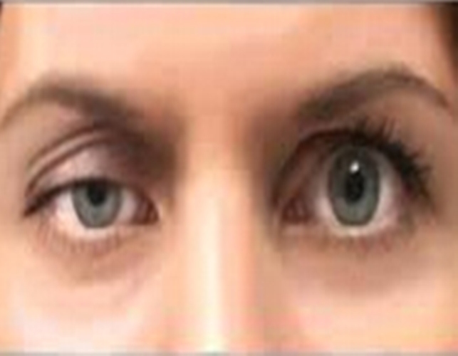 میاستنی؛شیوع 2برابری نسبت به ام اس اما ناشناخته
