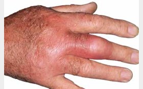 شکستگی استخوان انگشت را جدی بگیرید