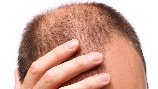 امیدی جدید برای درمان ریزش مو/ رشد دوباره مو با کمک نور LED