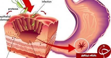 رایجترین علائم زخم معده چیست وچه زمانی بایدبه پزشک مراجعه کرد؟