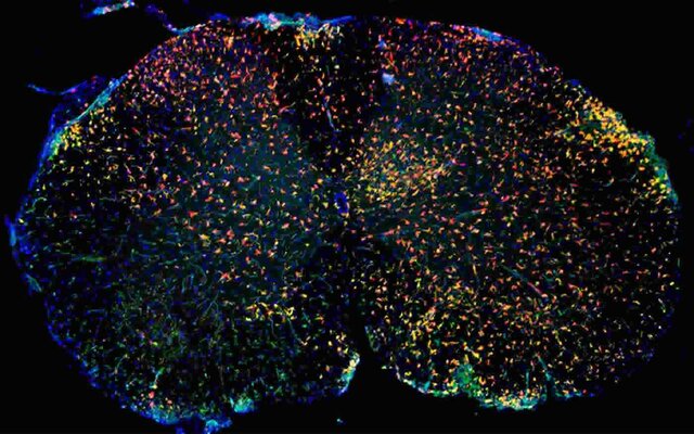 نوع جدیدی از سلول‌های ایمنی عامل بیماری ام‌.اس هستند