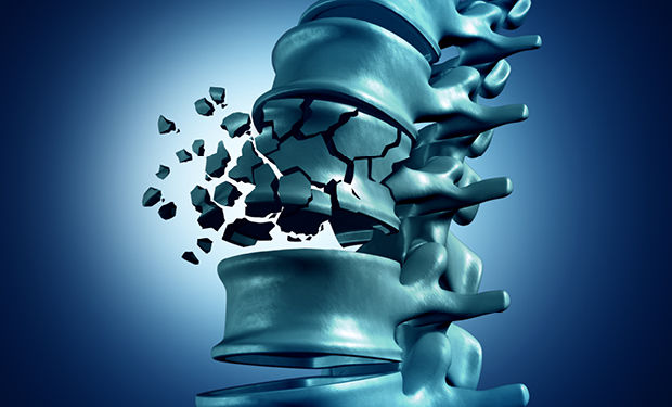 پوکی استخوان؛ بیماری پنهان که راه رفتن را برایتان دشوار می‌کند