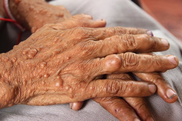 نوروفیبروماتوز، مهاجم ژنتیکی سیستم عصبی