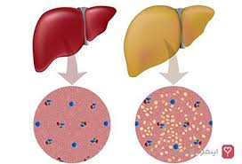 با چربی‌های سالم به جنگ کبدچرب بروید