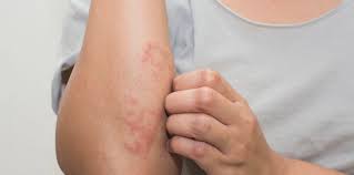 نشانه‌های حساسیت‌های غذایی چیست؟