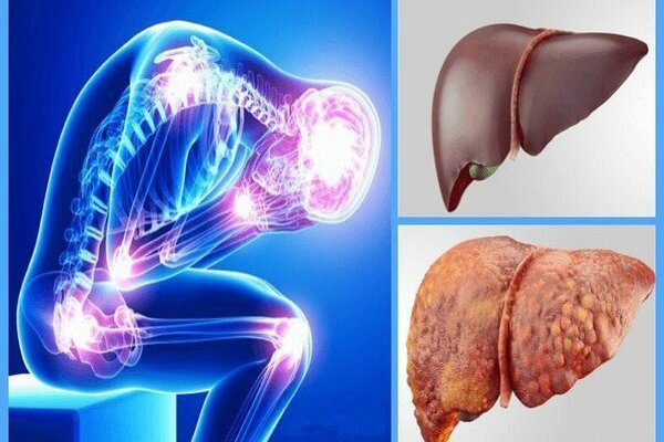 تاثیر سیاه‌دانه بر کبدچرب