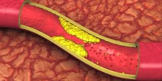 6 عامل بالا رفتن کلسترول خون