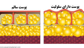 بهترین روش درمان سلولیت