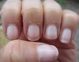 پوسته پوسته شدن اطراف ناخن